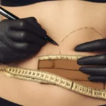 شفط دهون البطن ..كل ما تريد معرفته عن شفط الدهون