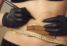 شفط دهون البطن