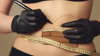 شفط دهون البطن