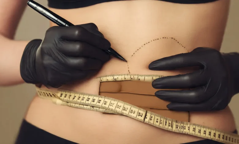 شفط دهون البطن