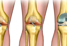 جراحة استبدال الركبة