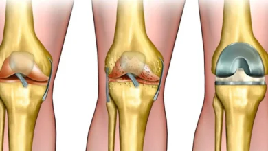 جراحة استبدال الركبة