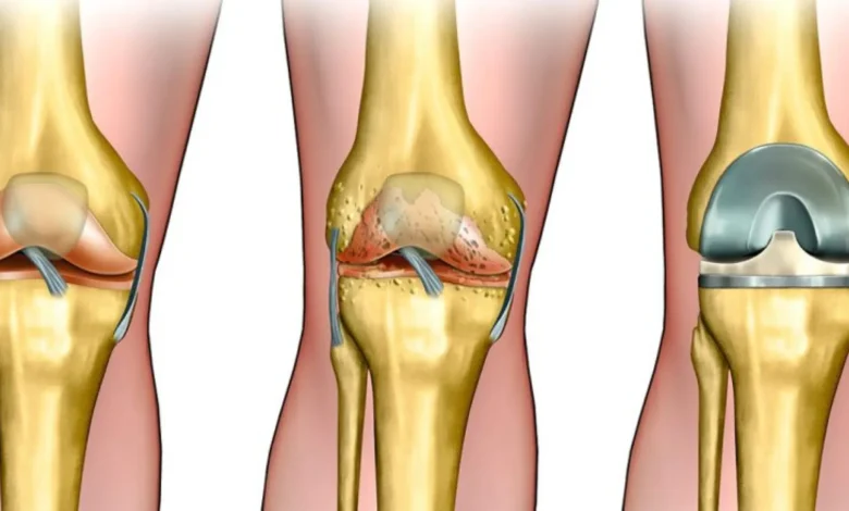 جراحة استبدال الركبة
