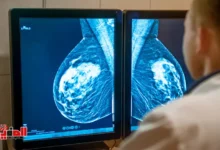 علامات ورم الثدي