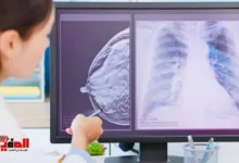 كيفية الكشف عن سرطان الثدي